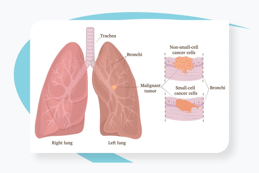Lung Cancer Treatment Specialists Daytona Beach FL